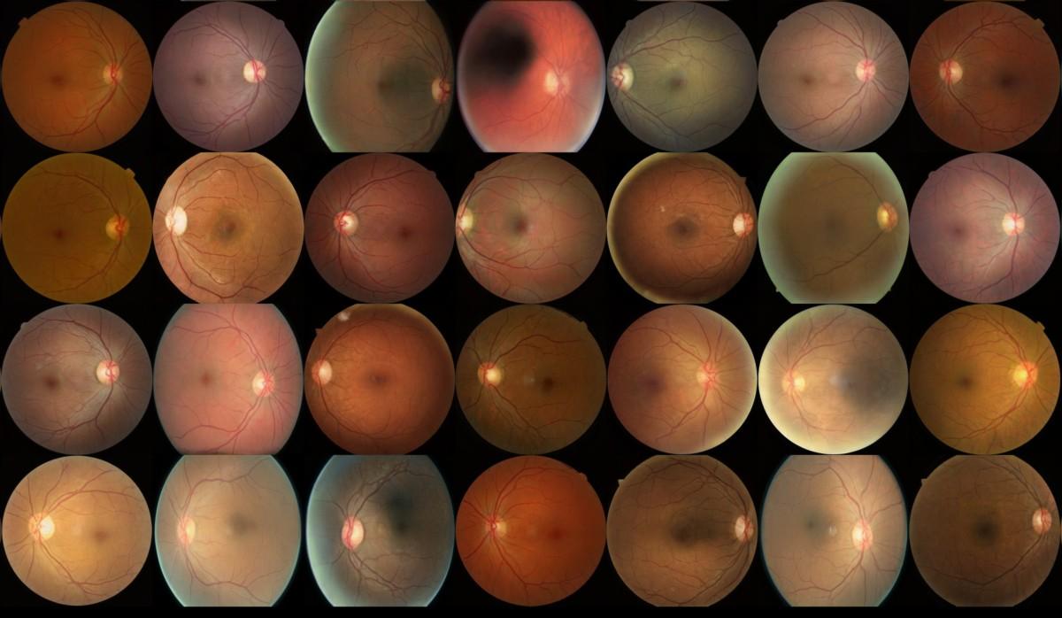 Enhancing Early Diabetic Retinopathy Detection through Synthetic DR1 Image Generation - A StyleGAN3 Approach